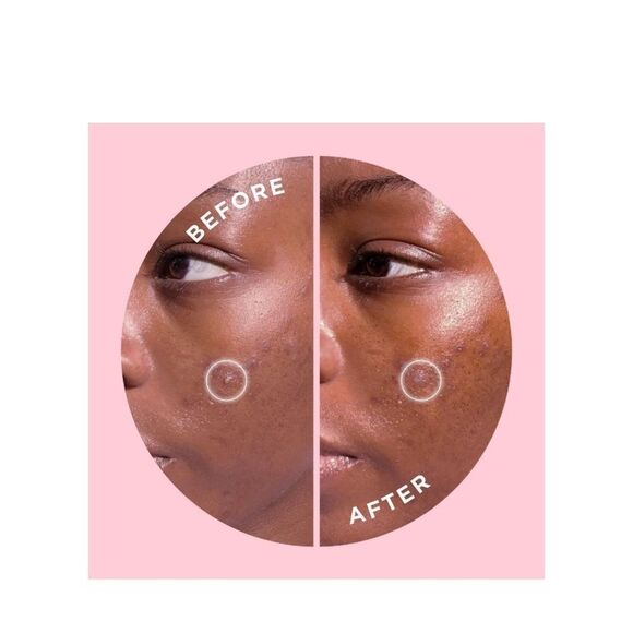 $4 🌙 Zitsticka Goo Getter Spot Clarifying Dots NEW (16) Dots NEW - Picture 4 of 7